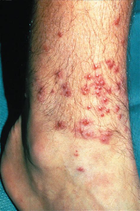 pictures of summer penile syndrome|pictures of chigger bites on humans.